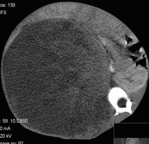 Fig. 17 - Cirurgia Fig. 24 Fig. 16 - TCcc Neufroblastoma "Gigante", Criança raça negra. Estadio II Fig.