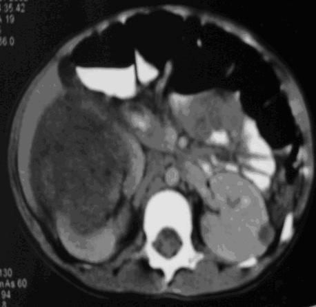 18 - Nefroblastoma Estadio III no rim drt., e foco de nefroblastomatose no rim Esq. Fig.