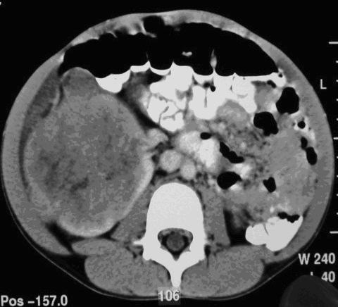 Fig. 21 - TCcc Lesão sólida heterogénea com extensa área de necrose. Trombo na veia cava inferior.