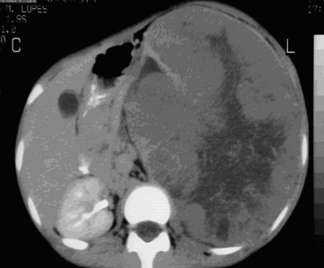 Trombo na Veia cava inferior Neuroblastoma Tumor da crista neural.