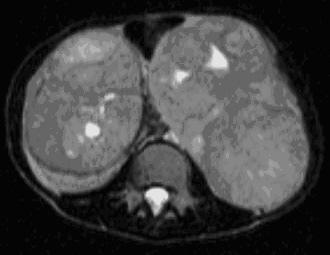 Apresenta um espectro contínuo segundo o grau de maturação: Neuroblastoma, Ganglioneuroblastoma