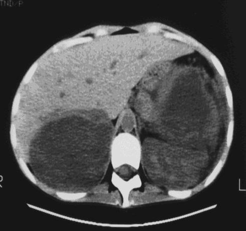 1º Tumor da Supra-renal neste grupo etário, representando 35% deste tumor, 30-34% extra- adrenal