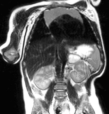 38, 39, 40 - TCcc Axial; Coronal, TCcc Crânio (janela de osso) Lesão