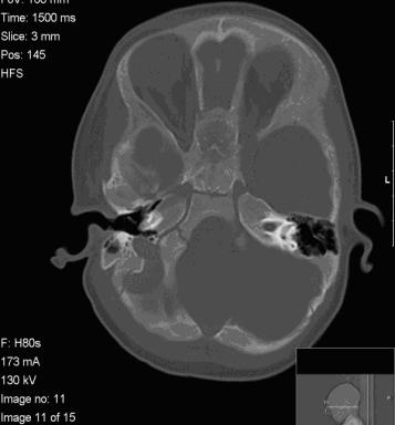 oncogéne N-myc.