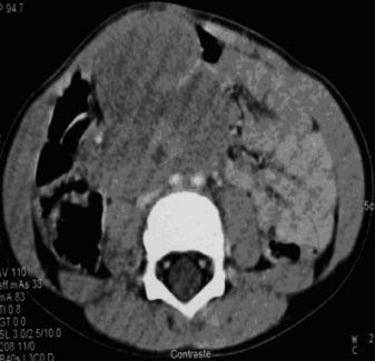 Neuroblastoma envolve-as. Fig.