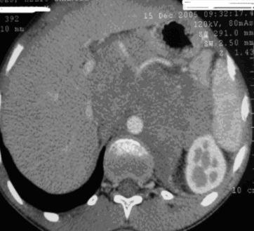 e espaço para renal Neuroblastoma II Fig.