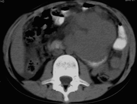 Cohen MD: Commentary: imaging and staging of Wilm s tumors: problems and controversies. Pediatr Radiol 1996; 26:307. Paterson A: Adrenal pathology in childhood, a Spectrum of disease.