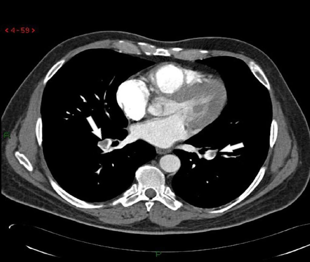 Figura 3. Falha de enchimento nas artérias lobares bilateralmente (setas brancas), indicando tromboembolismo pulmonar bilateral. (Pulmonar Case courtesyofdrsajoschasorrentino, Radiopaedia.