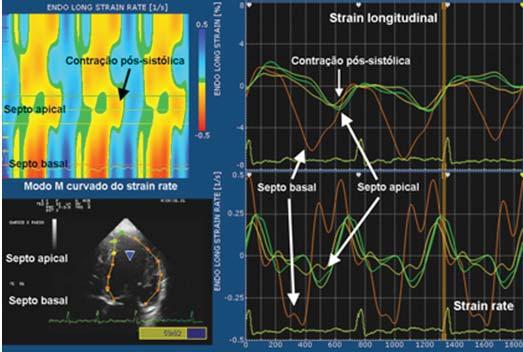 Figura 10 Strain longitudinal em paciente com infarto agudo do miocárdio na parede inferosseptal apical.