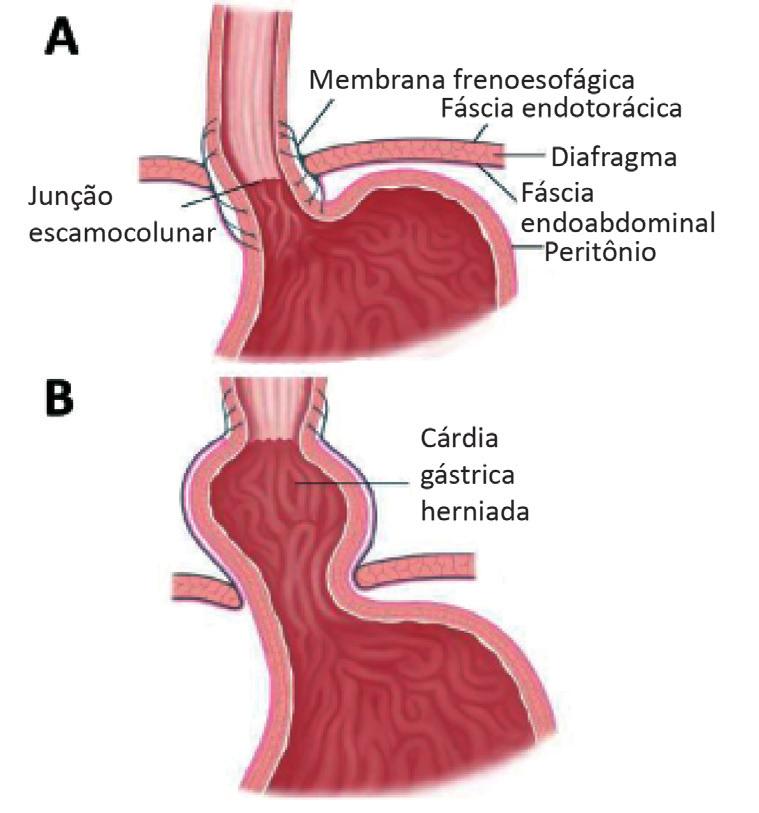varicoza de peritoneu)