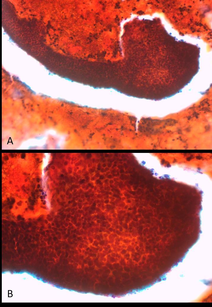 endocervical in situ; e núcleos aumentados e pleomórficos, distribuição irregular da cromatina, presença de macronucléolos e diátese tumoral evidente, para o adenocarcinoma endocervical invasor 5.