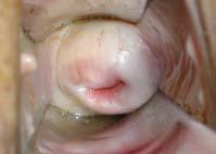 A - Peça cirúrgica de histerectomia radical evidenciando o útero e os linfonodos pélvicos.