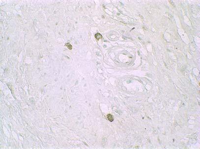 imunohistoquímica para a proteína p53 (600x de aumento).