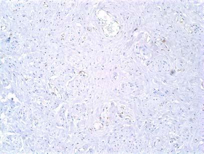 Casuística e Métodos 34 A B CD31 Grau 1 CD31 Grau 2 C CD31 Grau 3 Figura 3-7 - Fotomicrografias de carcinoma invasor do
