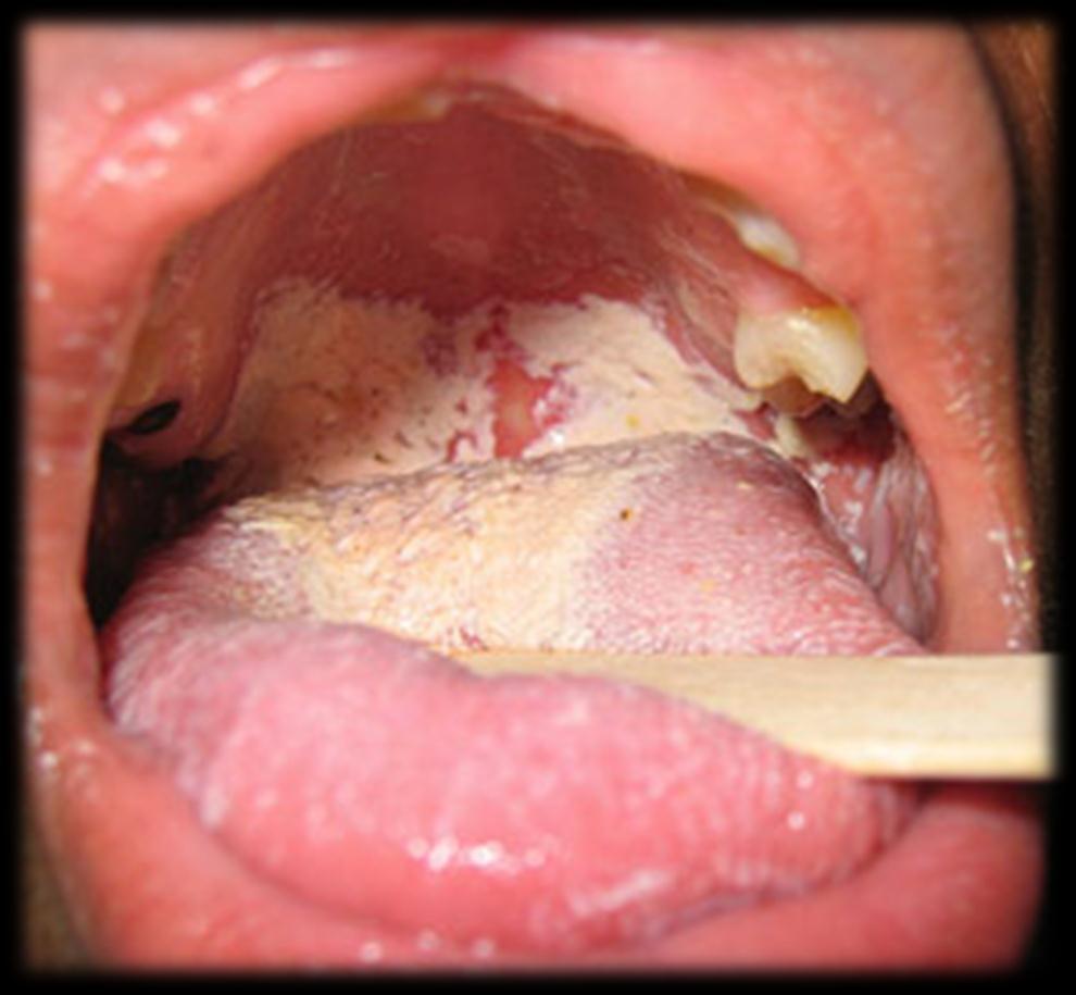 Candidíase Candidíase oral: consiste em placas brancas, na mucosa da boca ou da