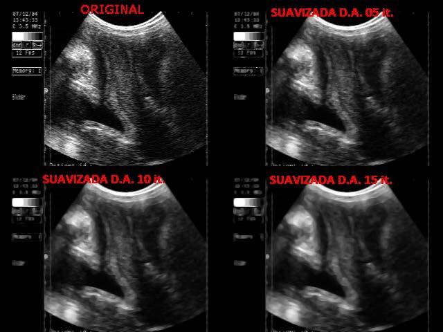 Introdução (Pré-)Processamento de Imagem: suavização de ruído por difusão anisotrópica