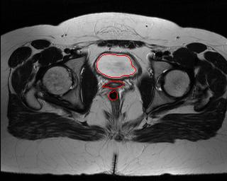 Segmentação de órgãos (bexiga, vagina, ânus) da cavidade pélvica (3 exemplos) Ma