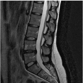 Técnicas quantitativas de imagem pós processamento Classificação semiautomática da degeneração do disco intervertebral em