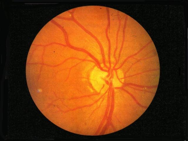 Retina Ocular