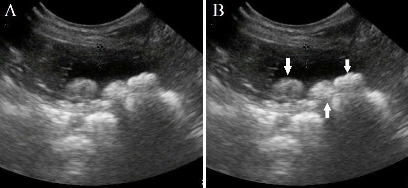 11 Ao exame ultrassonográfico foram observadas 3 a 4 estruturas hiperecoicas formadoras de sombra acústica posterior no lúmem vesical, compatível com cálculo vesical variando de 0,5 a 0,8 cm (figura