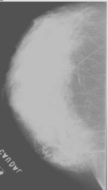 4 para aplicar o processo de transformação nos níveis de cinza de uma imagem mamográfica digitalizada no scanner laser de acordo com as