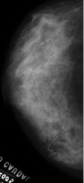 3 para aplicar o processo de transformação nos níveis de cinza de uma imagem mamográfica digitalizada no scanner laser de acordo com as