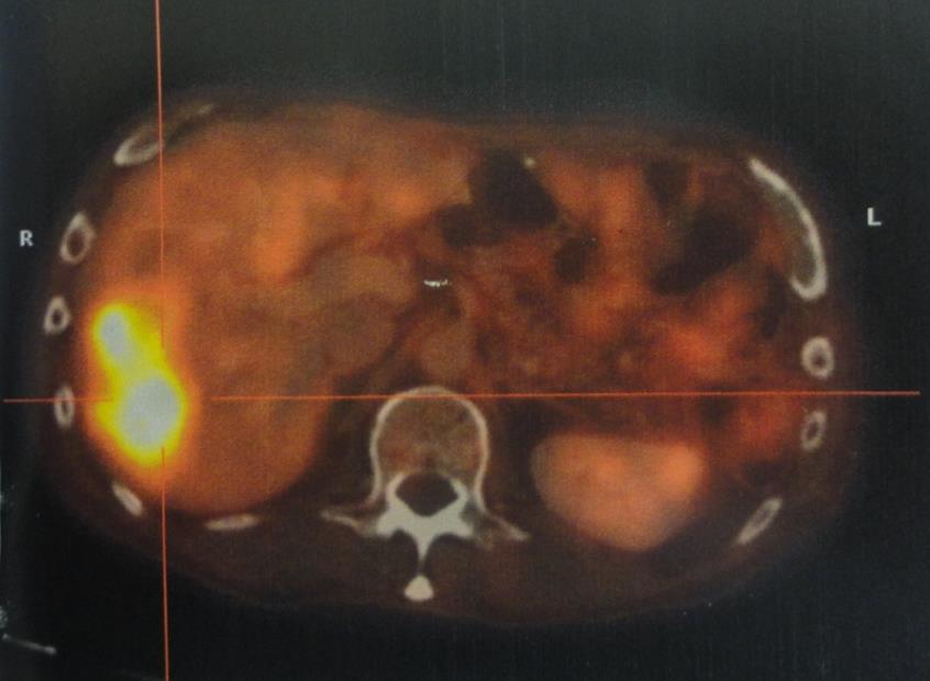 Paciente homem de 68 anos, submetido a gastrectomia subtotal por adenocarcinoma tipo intestinal de