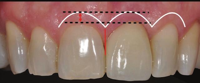 30 Para as próteses parafusadas, o longo eixo do implante deve coincidir com um plano entre a borda incisal e o cíngulo.