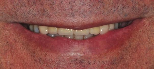 vertical de oclusão. Observar o dente 16 extruído em que foi indicado seu nivelamento por desgaste. Para a arcada inferior foi indicada a substituição do dentes artificias da PPR.