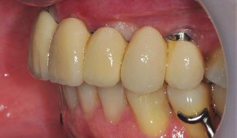 Assim, o primeiro paciente totalmente edêntulo foi tratado com implantes de titânio em 1965, de acordo com os princípios da osseointegração.