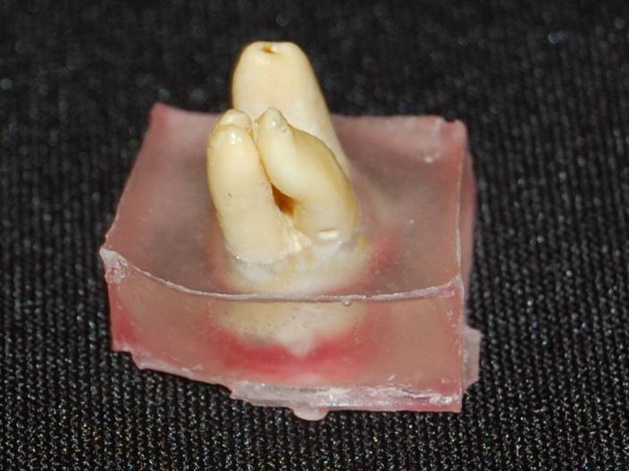 37 Figura 2- Dente incluso em bloco de resina acrílica Os dentes foram presos verticalmente em uma pequena morsa e assim iniciado o preparo cervical com brocas de Gates Glidden 1 e 2 de 32mm