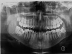 dentário da linha media, causando efeito sobre os dentes, a parte óssea, músculos, articulações e respiração, promovendo movimentos mastigatórios mais harmoniosos, com elementos dentários em chave de