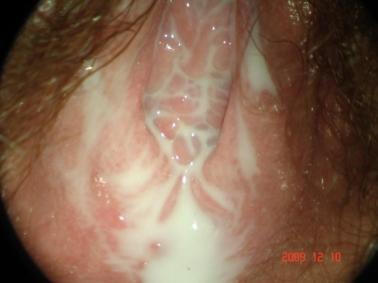 VULVOVAGINITES INTRODUÇÃO E DEFINIÇÃO Vulvovaginites e vaginoses são as causas mais comuns de corrimento vaginal patológico, responsáveis por inúmeras consultas aos ginecologistas.