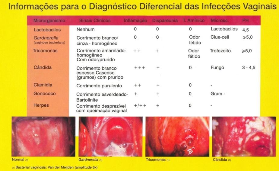 REFERÊNCIAS BIBLIOGRÁFICAS 1- Sobel JD. Vulvovaginal Candidosis. Lancet. 2007;369 (9577): 1961 71 2- Holland J; Young ML; Lee O; Chen S. Vulvovaginal carriage of yeast other than candida albicans.