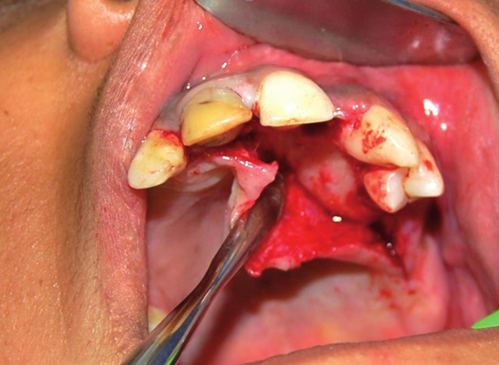 Contribuição da tomografia computadorizada por feixe cônico (cone beam) no diagnóstico e plano de tratamento do Odontoma Complexo Figura 2. Cirurgia.