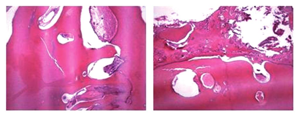 Presença de conglomerado irregular de esmalte, dentina, cemento e tecido pulpar (HE 100x) Discussão Os odontomas complexos correspondem a 25% dos casos de todos os tipos de odontomas e acometem em