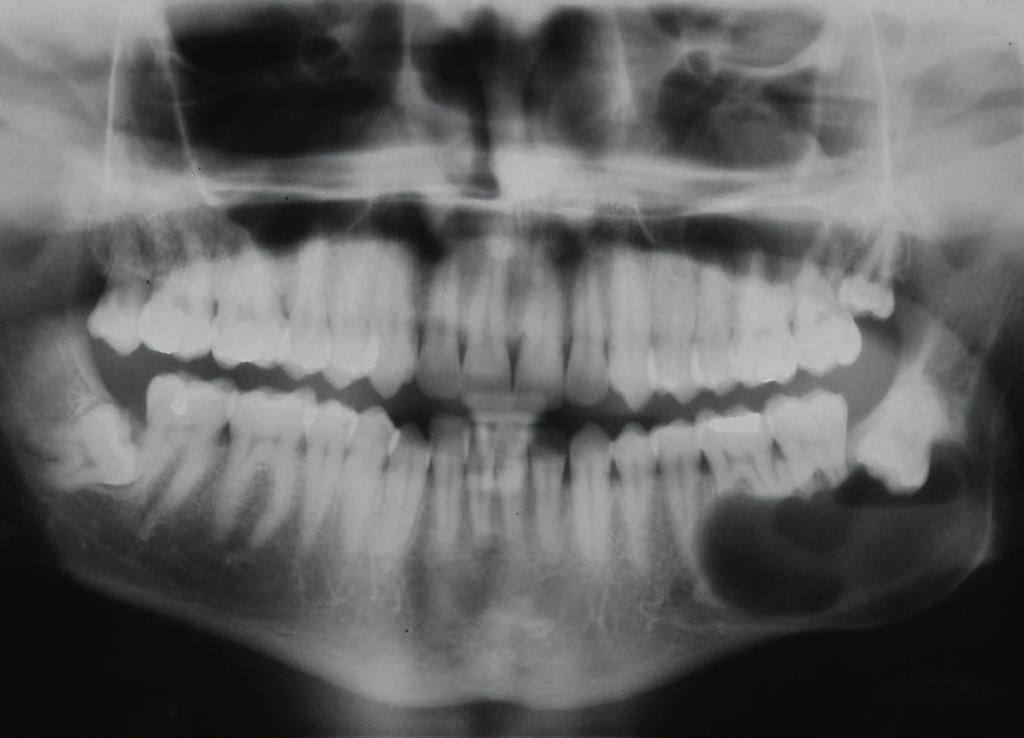 CTBMF INTRODUÇÃO Classificado como um cisto odontogênico de desenvolvimento, o cisto dentígero ou folicular origina se da separação do folículo da coroa de um dente incluso.