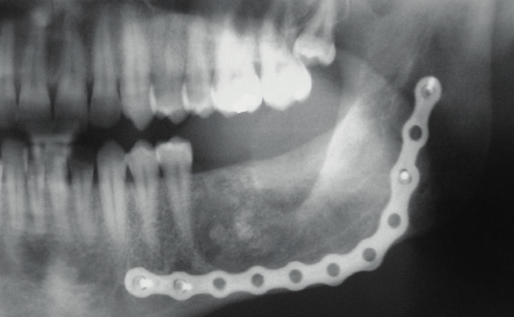 CTBMF FIGURA 6 Aspecto do osso neoformado após 8 meses FIGURA 5 Colocação de enxerto Ostin 35 e membrana em colágeno para proteção da região FIGURA 7 Implantes