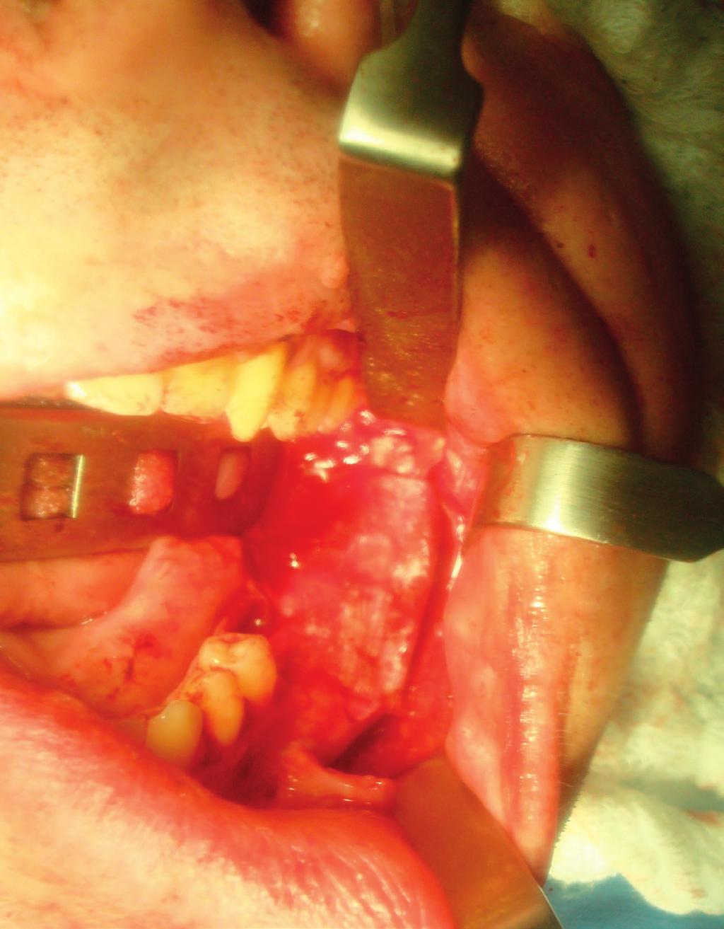 tamanho e a localização da lesão. O tratamento cirúrgico mais relatado é a enucleação do cisto e remoção do dente envolvido.