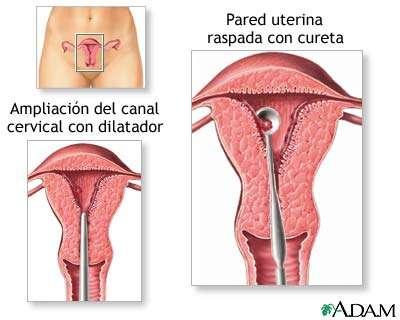 Aborto - Métodos Métodos 1o. Trimestre (0-12) Aborto Químico (misoprostol), Aspiração Uterina, Dilatação e Curetagem 2o.