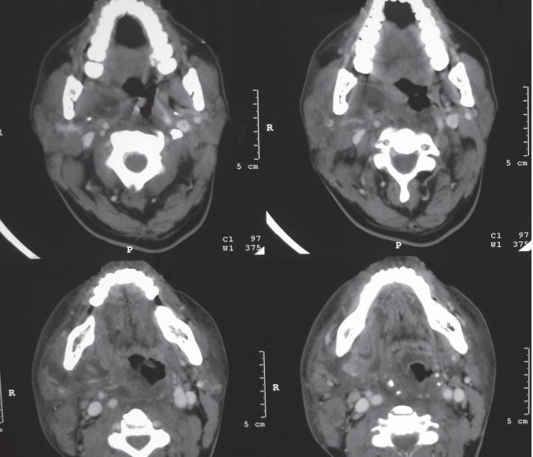 26 6 ANGINA DE LUDWIG A angina de Ludwig é uma celulite tóxica, aguda, difusa, de rápida progressão, de consistência firme (lenhosa) que envolve os espaços fasciais submandibular, e sublingual