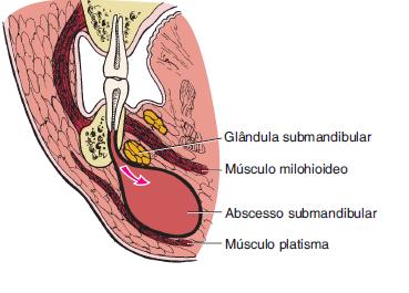 27 lingual, fratura de mandíbula, laceração oral, trauma de intubação e broncoscopia. Em crianças, a amigdalite é uma causa possível.