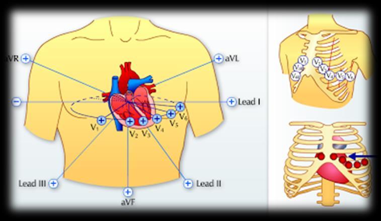 E, 4º EIC; Entre V2 e V4; Linha hemiclavicular E, 5º EIC; Linha axilar