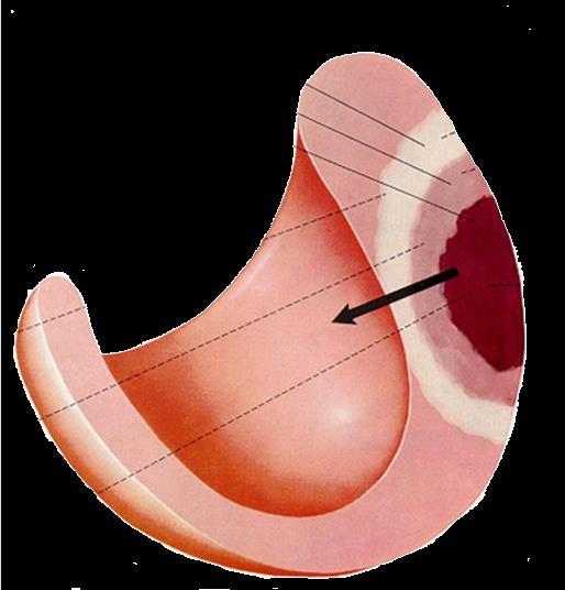 Quais as alterações eletrocardiográficas no IAM?