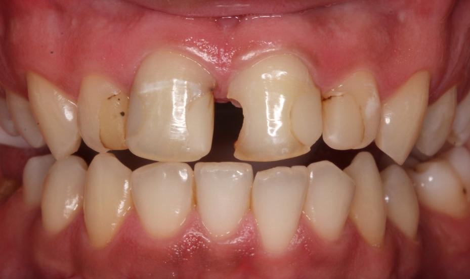 Fialho et al./ Uningá Review avaliação, devido à extensa quantidade de material resinoso e acometimento do remanescente dental, foi recomendada a substituição destas por materiais cerâmicos.