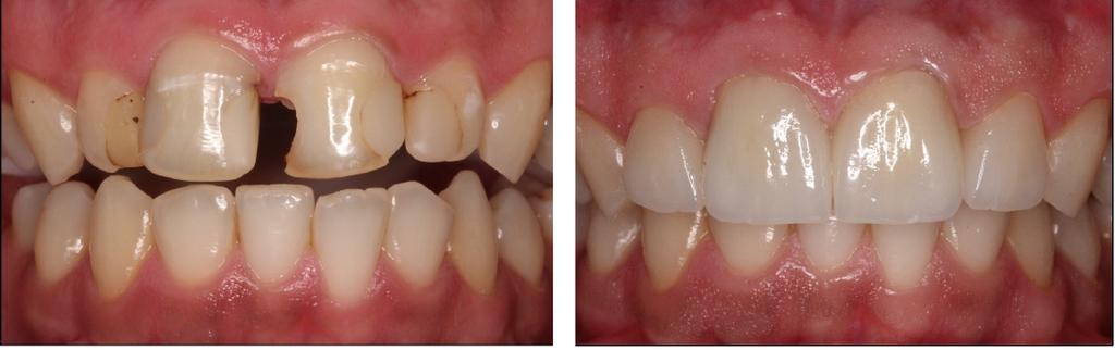 fluorídrico a 10% (Condac Porcelana FGM) por 20s e, então, silanizadas (Prosil - FGM).