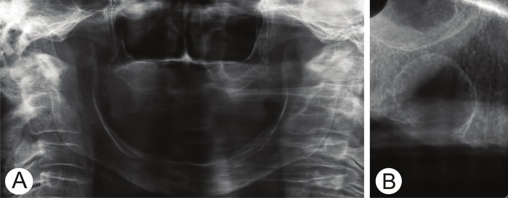 Ao exame físico intraoral, verificou-se que a paciente era edêntula total e apresentava uma lesão nodular, exofítica, com coloração semelhante à da mucosa, localizada na região palatina de rebordo