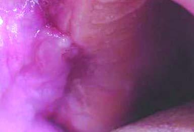 Figura 5 - Sutura do corpo adiposo bucal na mucosa palatina No décimo dia, removeu-se a sutura de Nylon e observou-se uma total coaptação das bordas da ferida e ainda, presença do tecido adiposo.