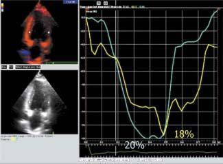 de Chagas, através da medida do strain miocárdico obtido pela ecocardiografia com Doppler tecidual e definir se existem diferenças na função contrátil radial e longitudinal do miocárdio entre as