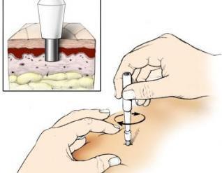 PROCEDIMENTOS PARA COLETA DE AMOSTRAS Escarro: Recolher, de preferência, a primeira expectoração da manhã, após gargarejo com água limpa ou fervida, em frasco de boca larga, esterilizado.